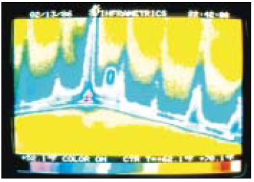 How to grow mold. This thermograph looks at the corner of the house from the inside. The fan of a blower door is depressurizing the house (sucking air out the door), so cold outdoor air is being drawn in through cracks in the exterior wall. The blue areas show where cold air is infiltrating underneath the wall plate and around an electrical outlet. This cold air will reduce the surface temperatures, thereby increasing the surface relative humidity and the chance for mold growth. The cure includes a breathable exterior housewrap with the seams taped as well as sill seal and other air-sealing measures — all elements of a good air-barrier system.
